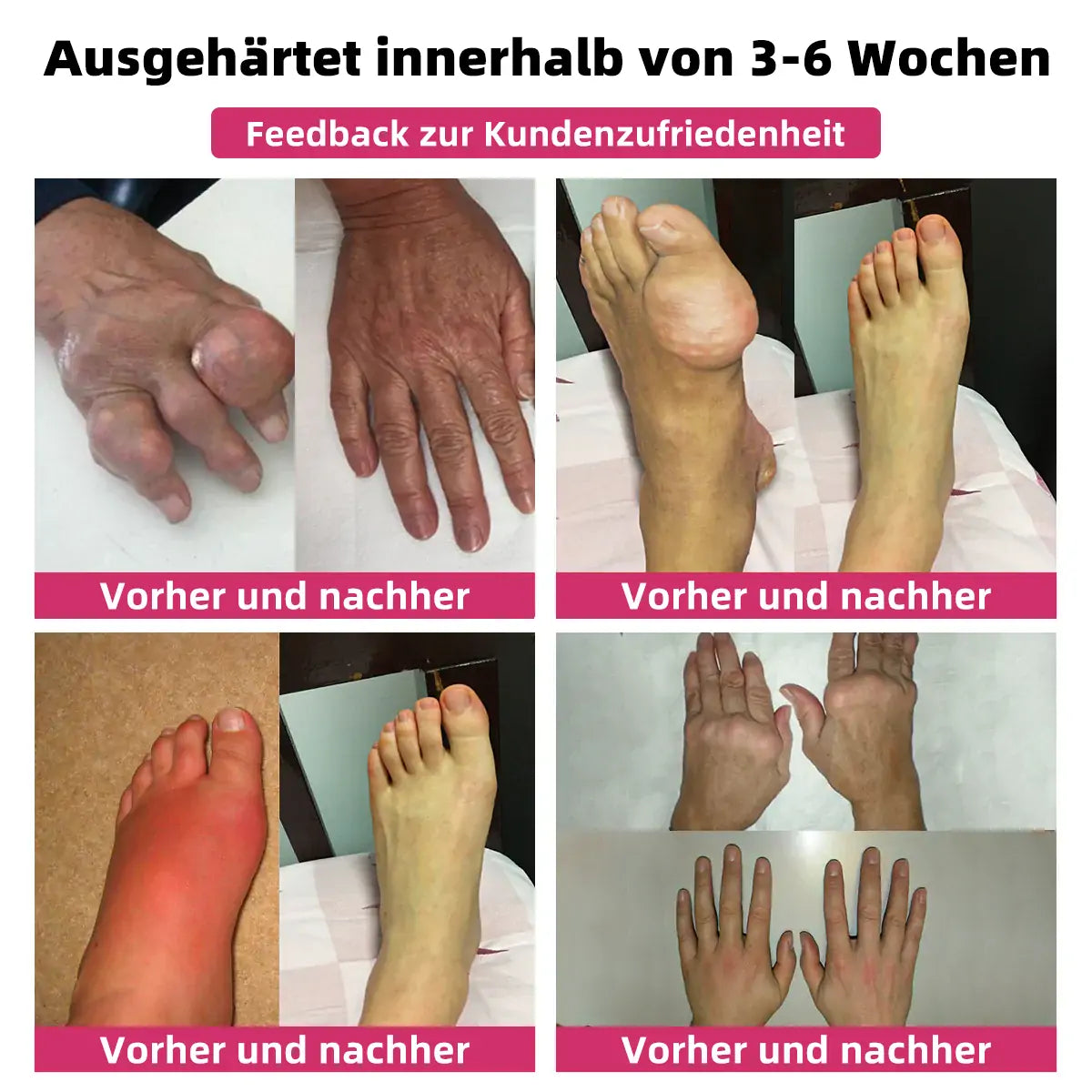 ๐ฅ๐ฅ๐๐ง๐ง๐๐๐๐ฒยฎ Biegift Smertelindrende og Behandlende Krem for Benhelse๐จโโ๏ธ๐ค (Spesielt for eldre voksne og anbefalt av DGOU)๐
