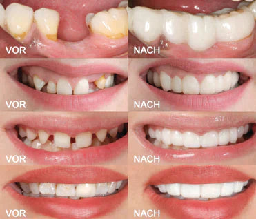 🌷😁 Sista dagen rabatt - 75% rabatt 💝 Senaste 👨‍⚕ Justerbar Snap-In Denture 🦷 - Exklusiva erbjudanden