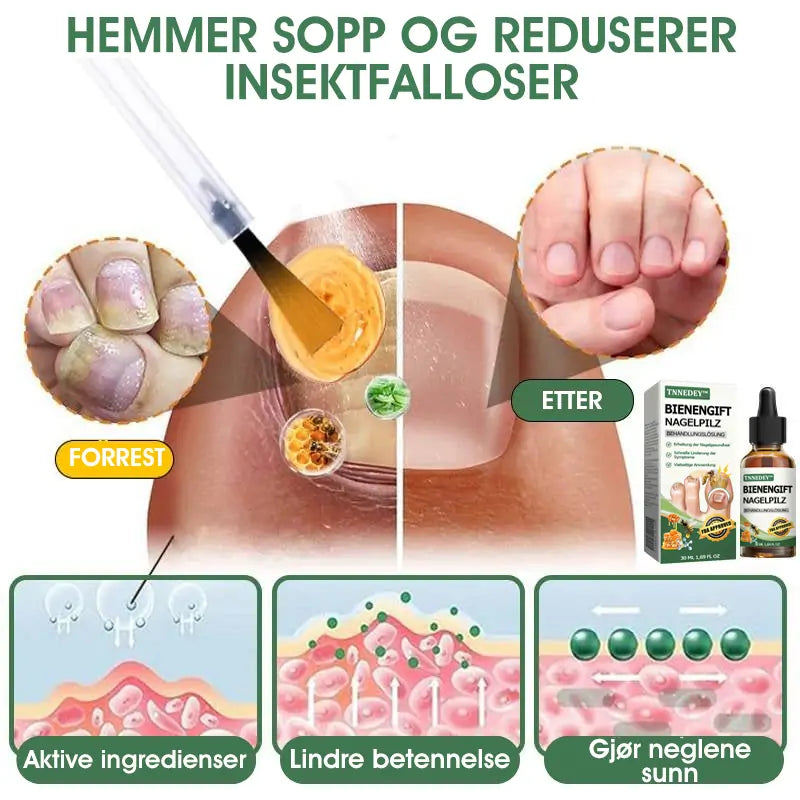 👩‍⚕️TNNEDEY™ Biegift Neglesopp Behandlingsløsning: Løs neglesopp-problemet fullstendig 🌟👣