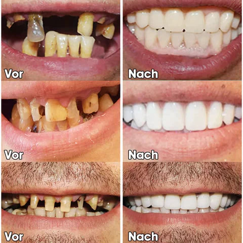 🌷😁 Sista dagen rabatt - 75% rabatt 💝 Senaste 👨‍⚕ Justerbar Snap-In Denture 🦷 - Exklusiva erbjudanden