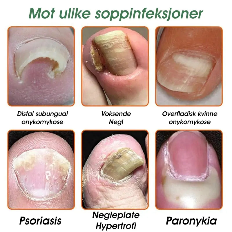 👩‍⚕️TNNEDEY™ Biegift Neglesopp Behandlingsløsning: Løs neglesopp-problemet fullstendig 🌟👣